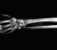 soft splint